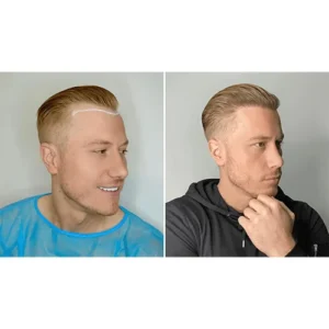 Hair transplant