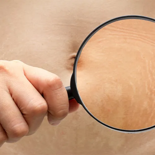 کربوکسی تراپی ترک پوستی