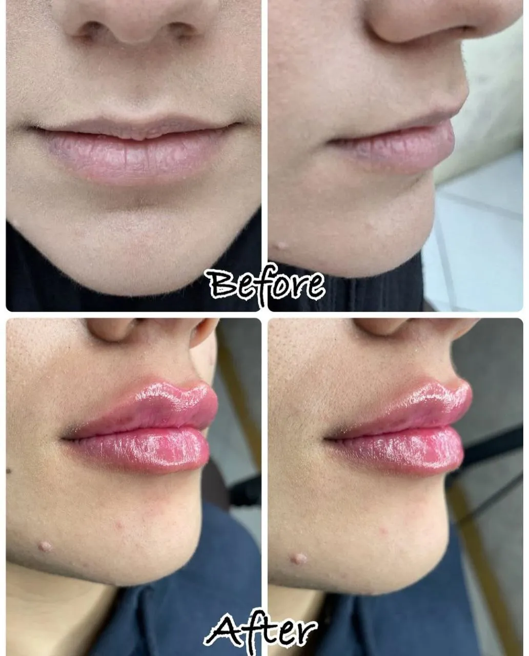 تزریق فیلر لب