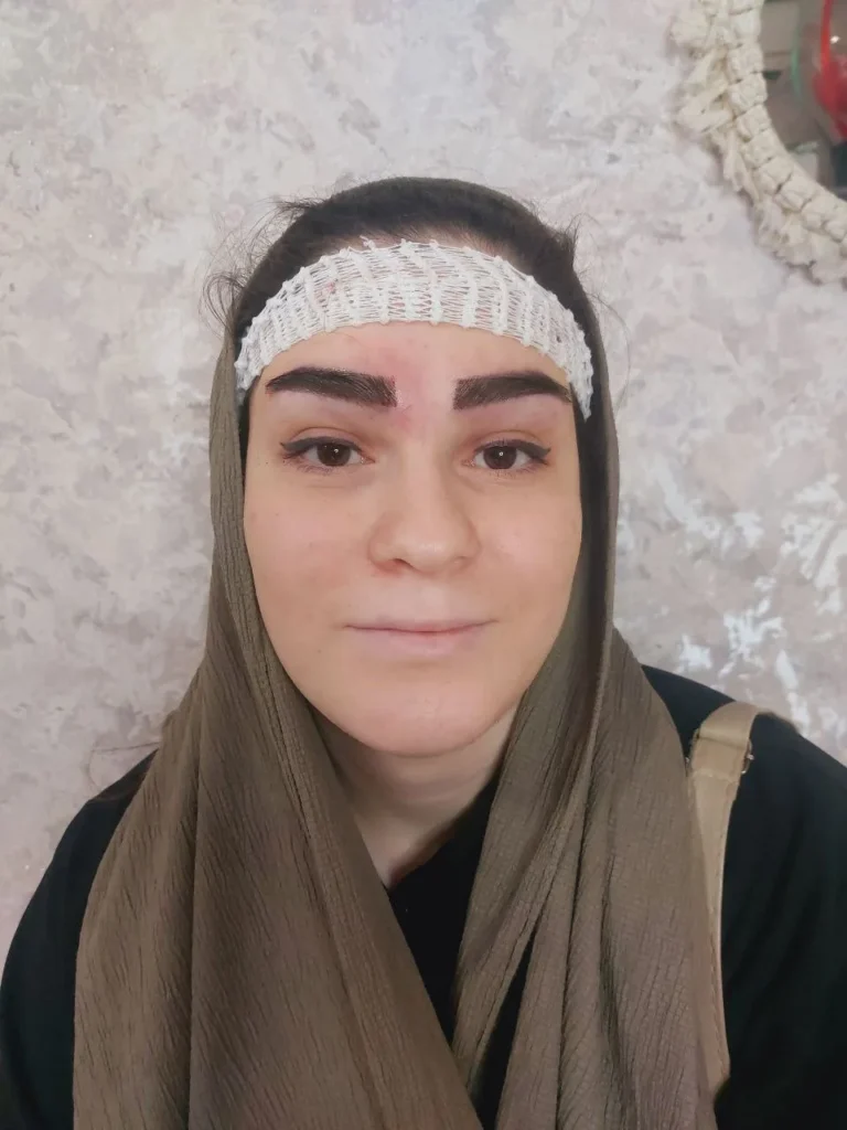 کاشت ابرووووو